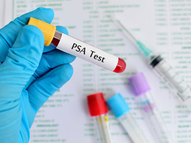 10 señales de alerta del cáncer de próstata - 4. Proteína PSA elevada