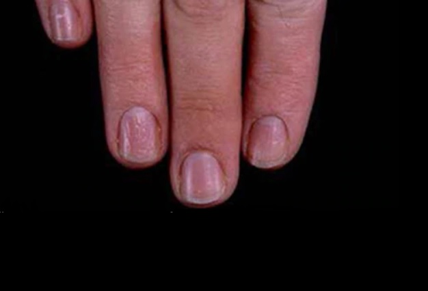 10 cambios en las uñas que pueden revelar una enfermedad - 5. Uñas punteadas 