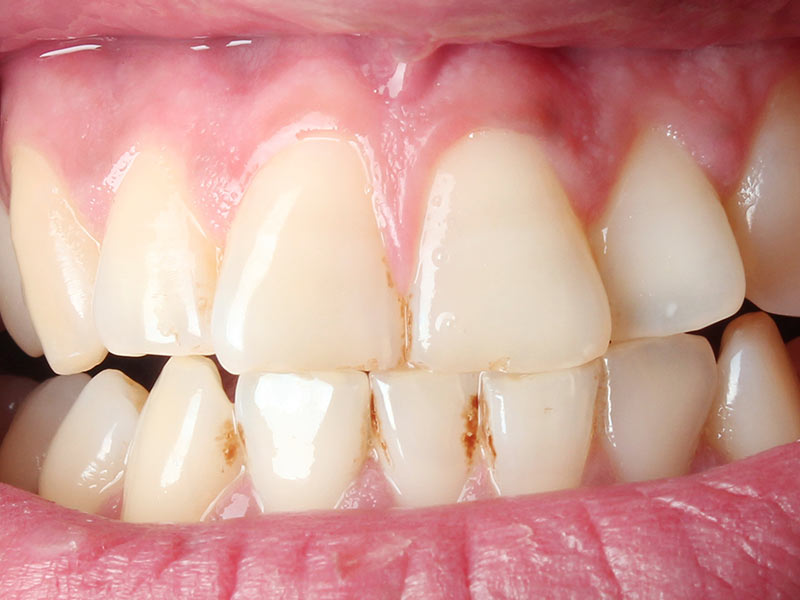 Por qué los dientes se ponen amarillos - 5. Mala higiene