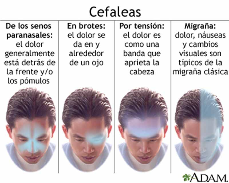 ¿Qué es la cefalea tensional y cómo se trata? - ¿Cómo reconocer una cefalea tensional?