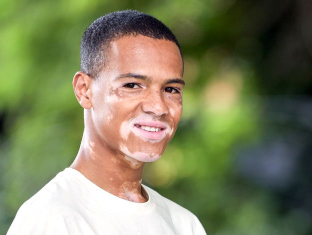 Famoso con vitiligo triunfa a los 20 años - Manchas en el ánimo