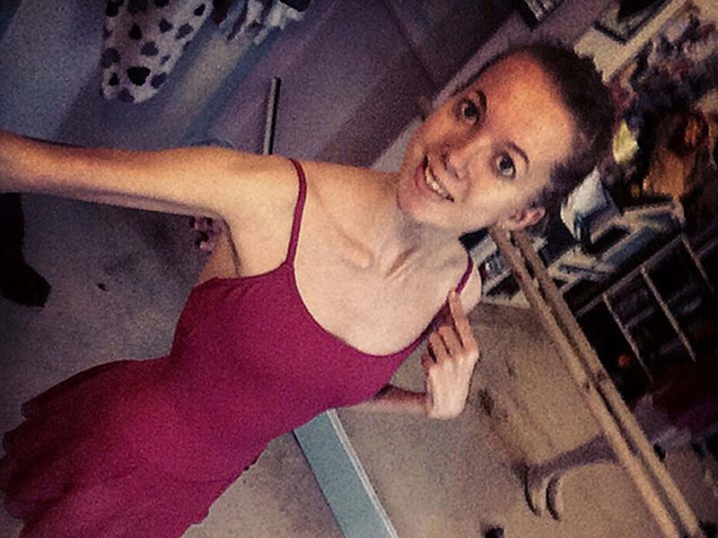 El ballet la salvó de la anorexia - Signos de anorexia nerviosa