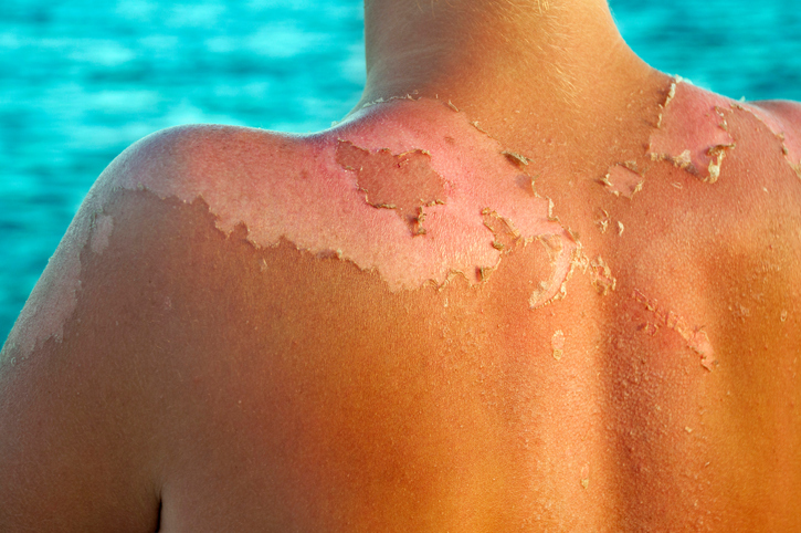 5 pasos para evitar tener cáncer de la piel - Preocupante
