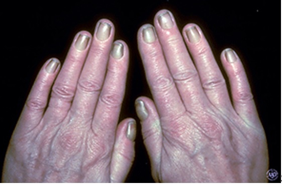 10 cambios en las uñas que pueden revelar una enfermedad - 6. Síndrome de las uñas amarillas