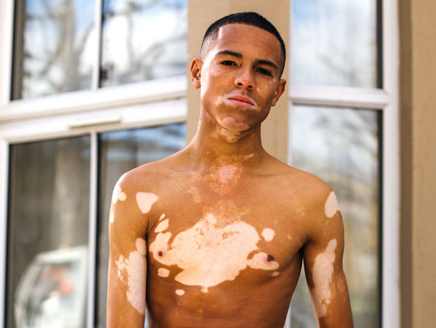 Famoso con vitiligo triunfa a los 20 años - Tratamientos quirúrgicos