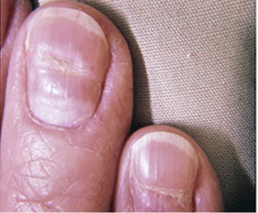 10 cambios en las uñas que pueden revelar una enfermedad - 7. Ranura profunda en la uña