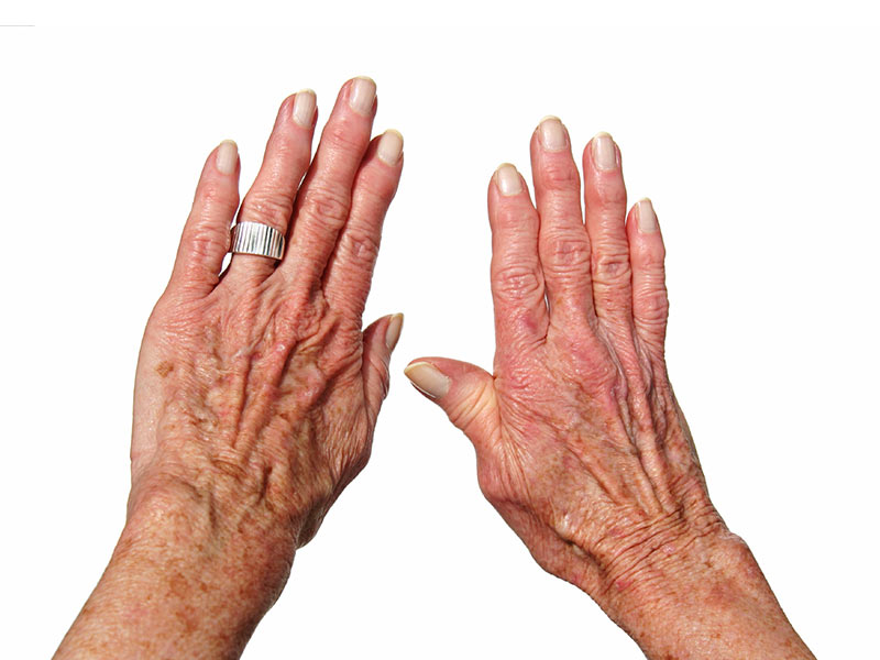 10 señales de alerta de la artritis - 7. Edad 
