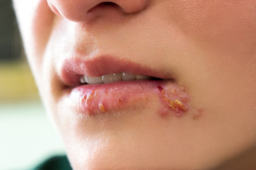 Cuáles son los síntomas del Herpes - Signos del Herpes labial