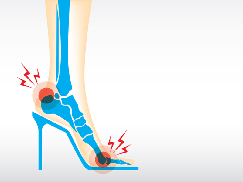 Artritis, lesiones y otros daños de los tacones altos - 8. Deformidad del talón