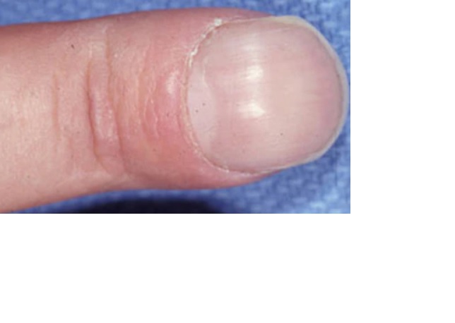 10 cambios en las uñas que pueden revelar una enfermedad - 8. Uña curvada